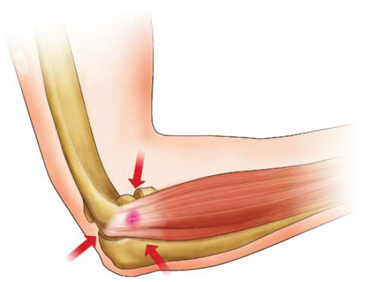 La epicondilitis, una lesión muy habitual en el pádel